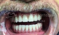 Восстановление зубов на верхней и нижней челюсти - Фотография 2